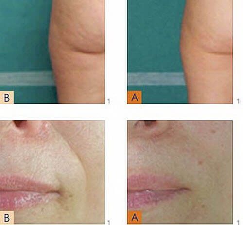 cellulite reduction