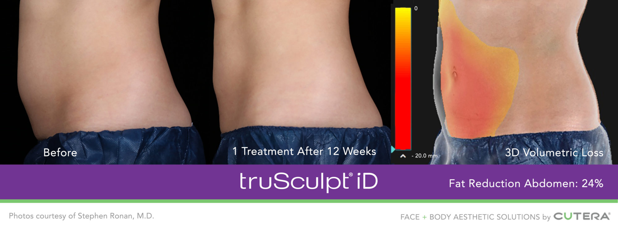 truSculpt-iD-Ronan-4